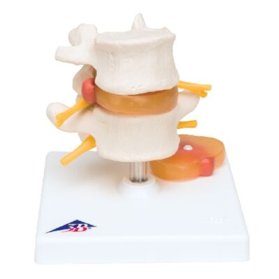 Colonna vertebrale lombare con disco intervertebrale prolasso