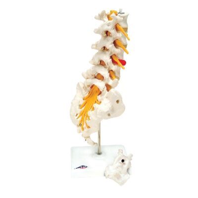 Colonna vertebrale lombare con disco intervertebrale prolasso dorso-laterale