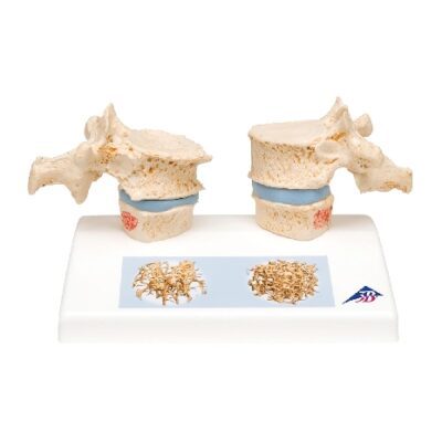Modello dell’osteoporosi