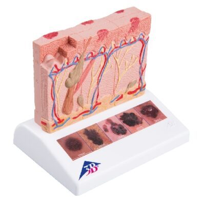 Modello di cancro della pelle