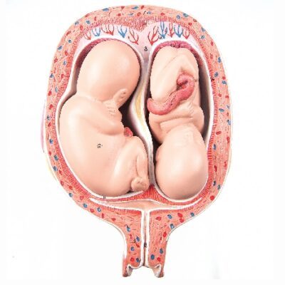 Feti gemelli del 5° mese – Posizione normale
