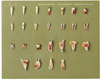 Caso dei denti “Odontopatie”