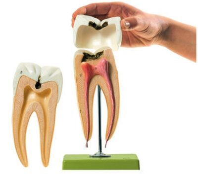 Dente molare con carie