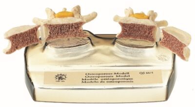 Modello dell’osteoporosi