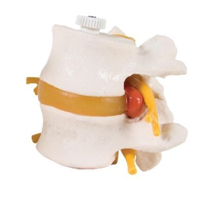 2 vertebre lombari con prolasso del disco, montate in modo flessibile