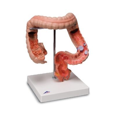 Malattie intestinali