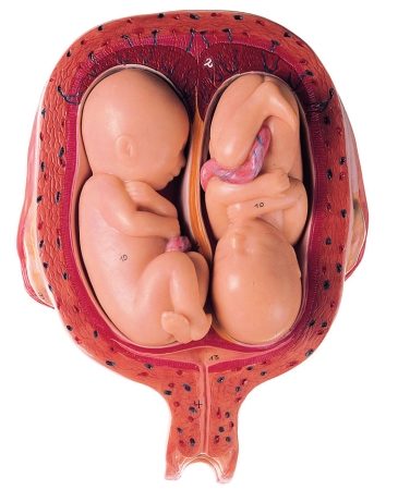 Utero con feto gemello al quinto mese